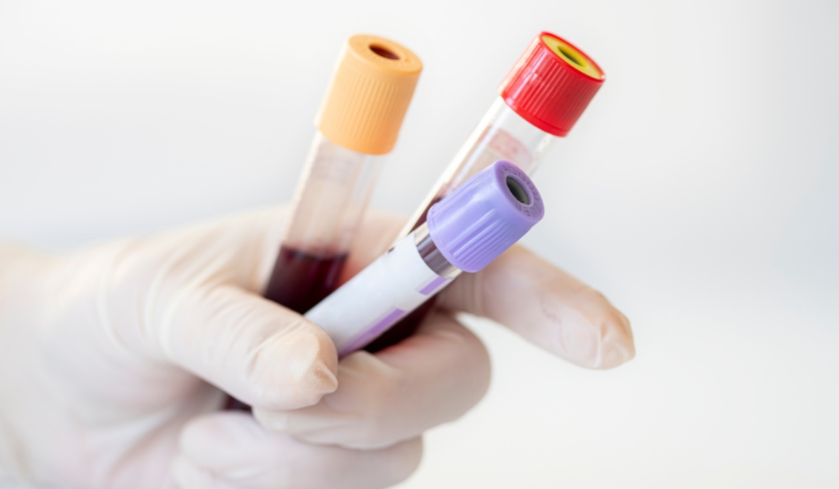 Blood tests before an iron infusion what you need (and when to repeat)