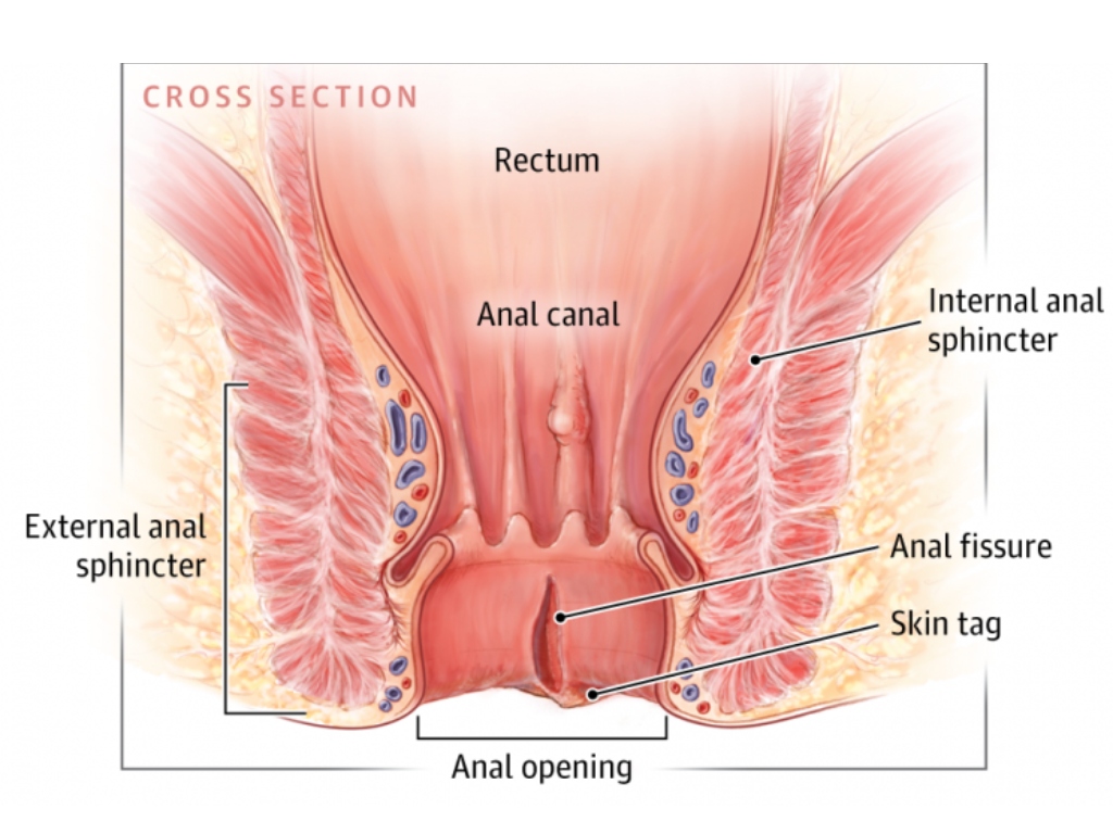 Anal Fissure