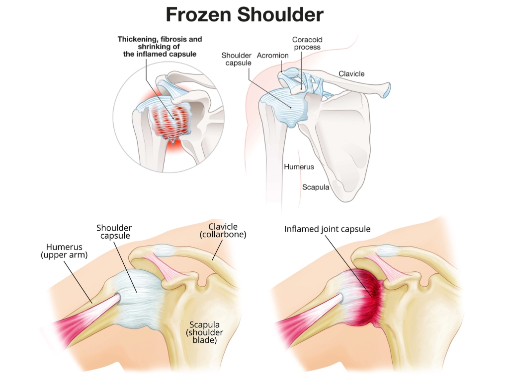 Frozen Shoulder