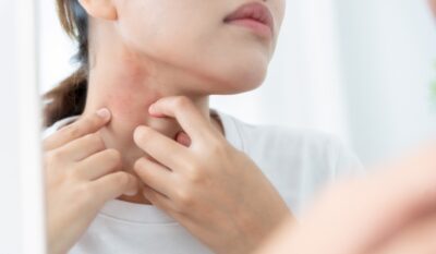 Mast Cell Activation Syndrome (MCAS): A UK Clinical Overview