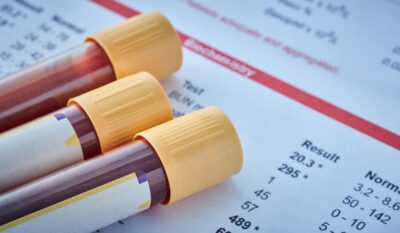 The Galleri® Multi-Cancer Early Detection Test
