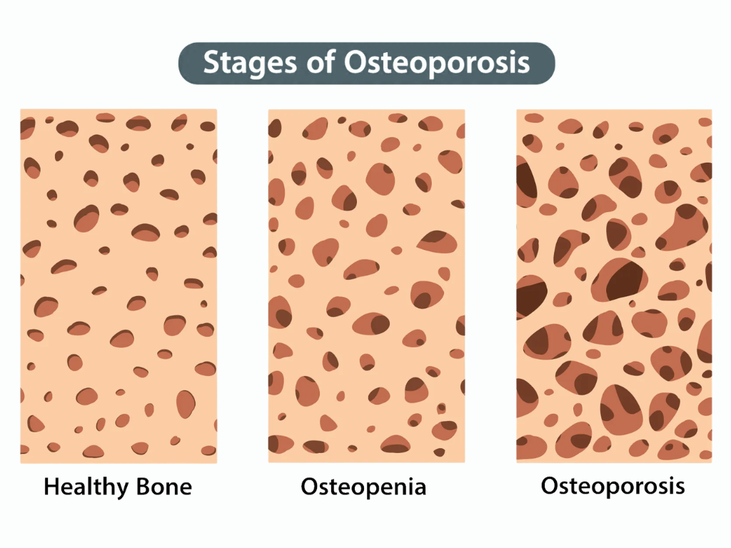 osteopenia