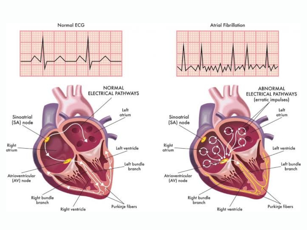 Atrial Fibrillation