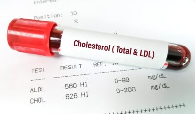 Beyond Standard Cholesterol: Why ApoB, Lp(a) and Lp-PLA2 Matter