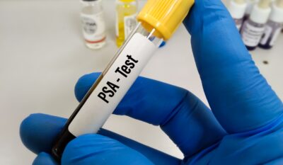 PSA Test Explained: Should You Have One and What Do the Numbers Mean?